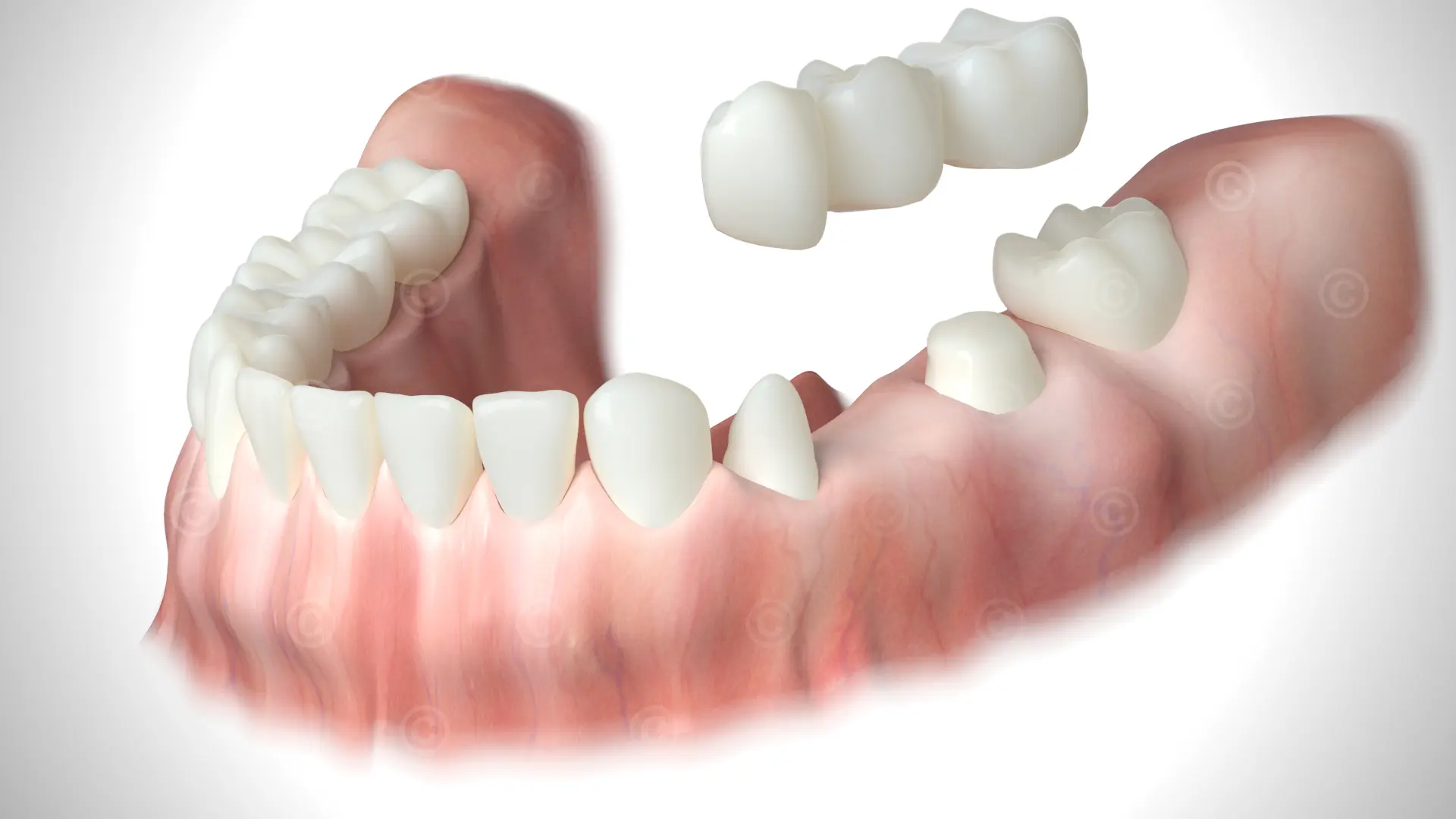 Dental Bridges