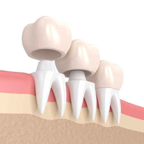 Dental Crowns