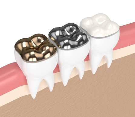 Dental Filling