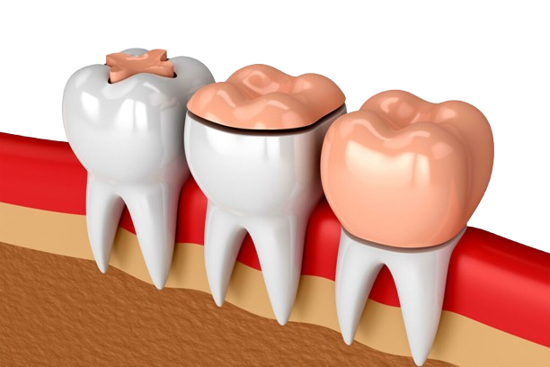 Dental Filling Treatment