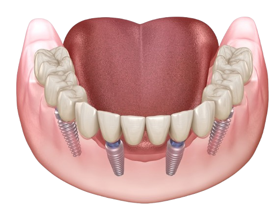 Full Mouth Rehabilitation