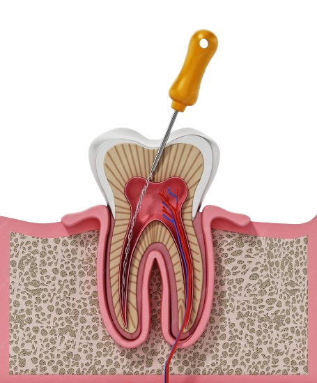 Root Canal Treatment