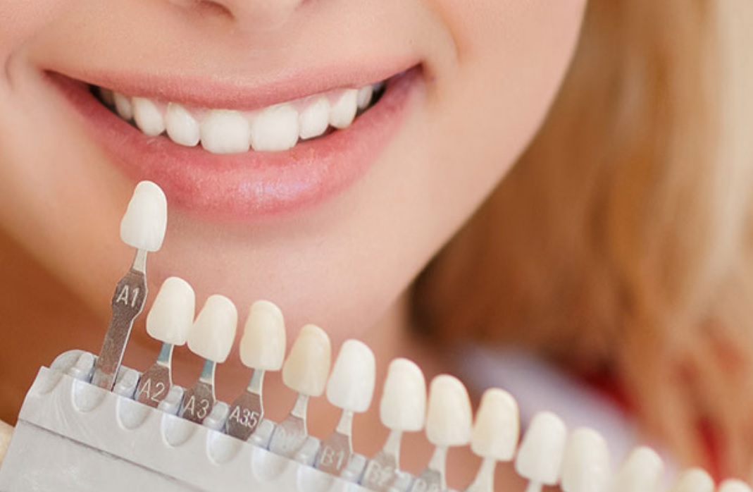 Veneers
