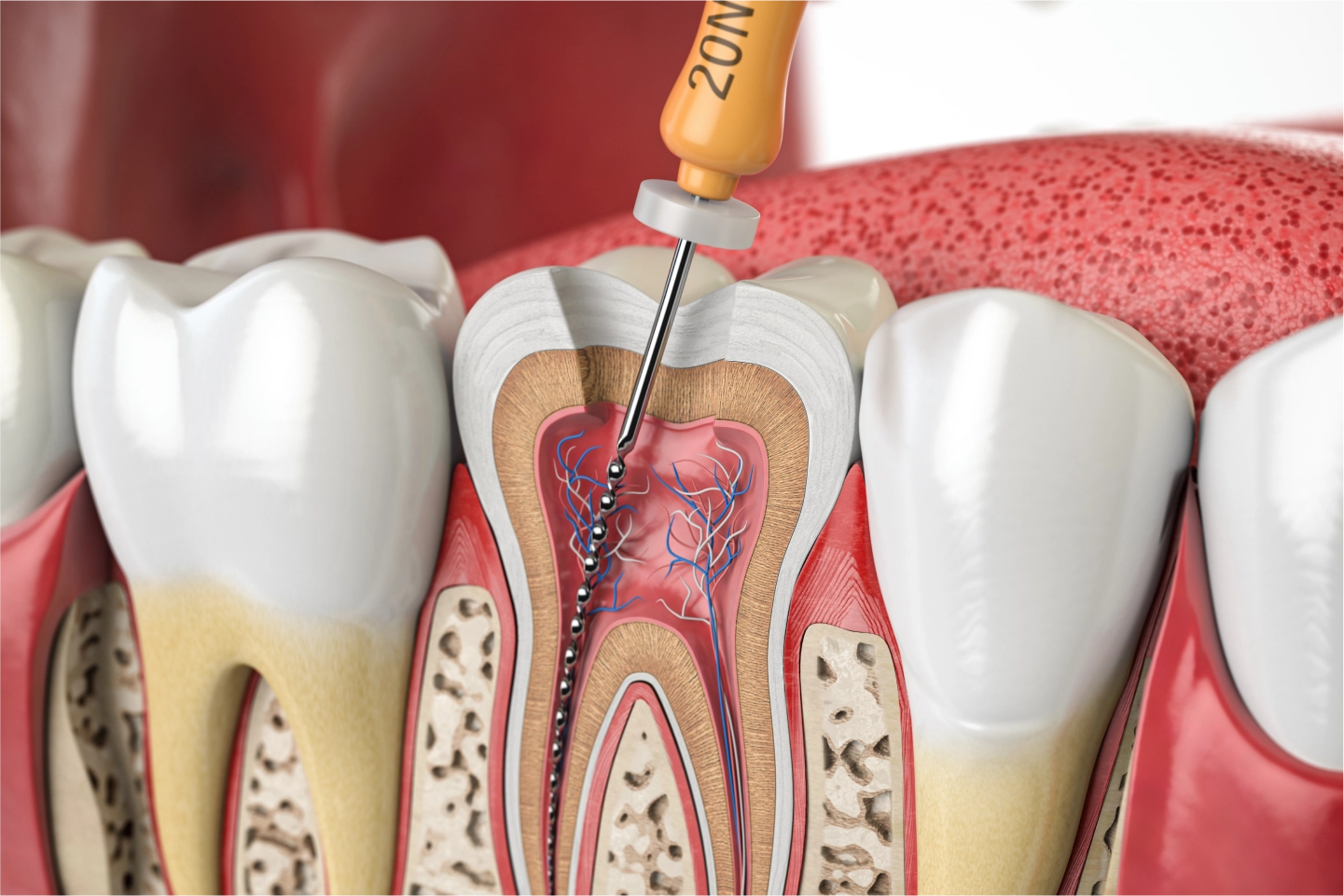 Root Canal