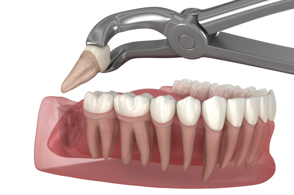 Wisdom Tooth