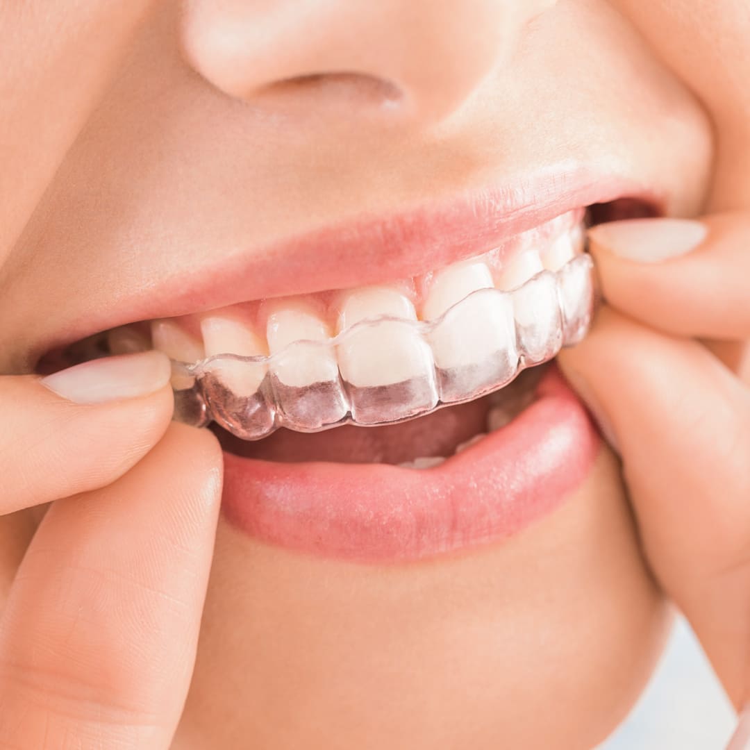Aligners