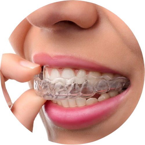 Dental Aligners