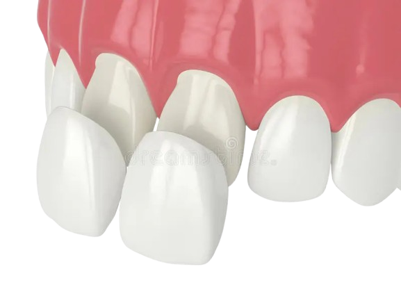 Dental Veneers