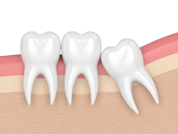 Wisdom Tooth Extraction