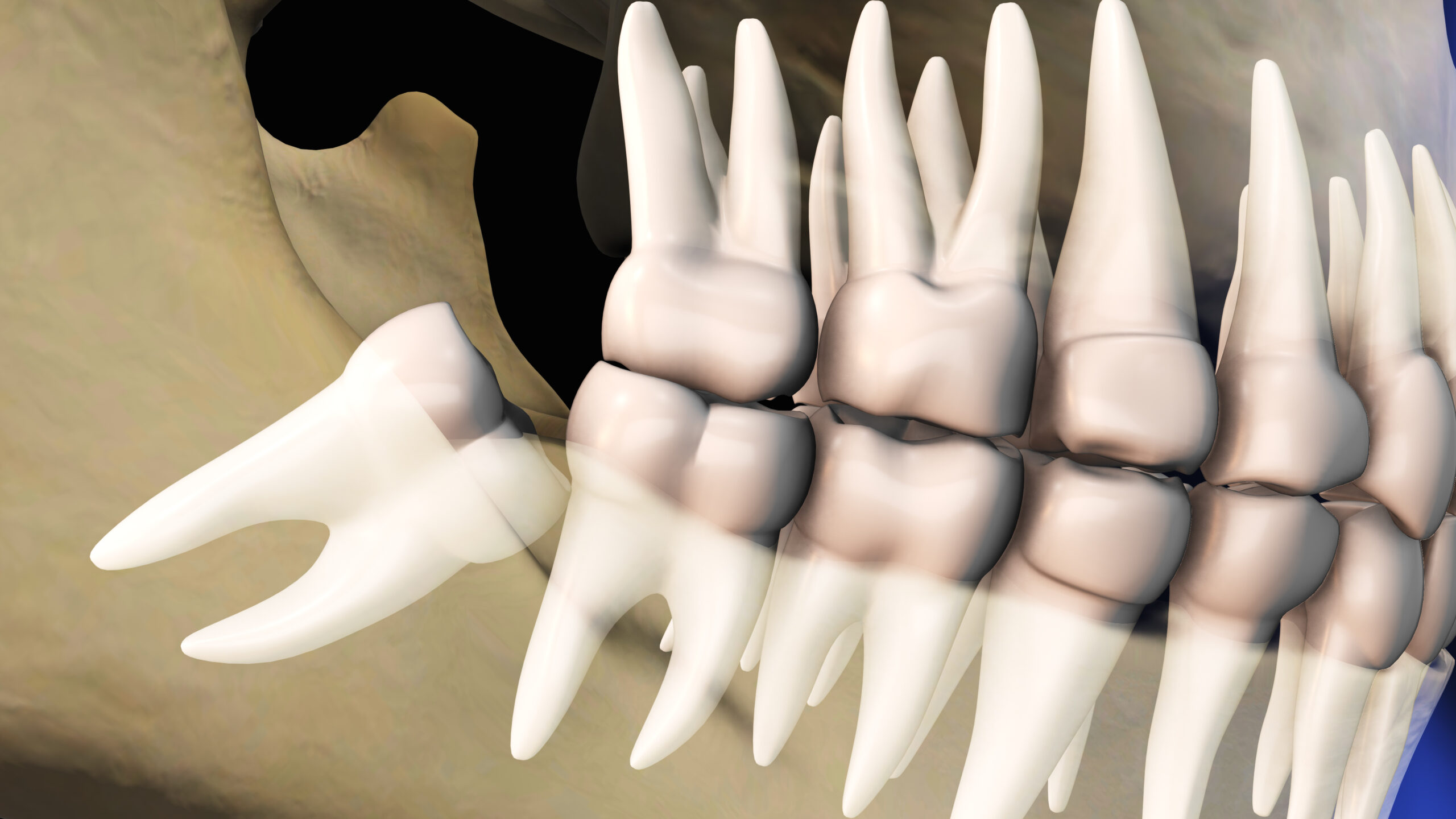 Wisdom Tooth Removal